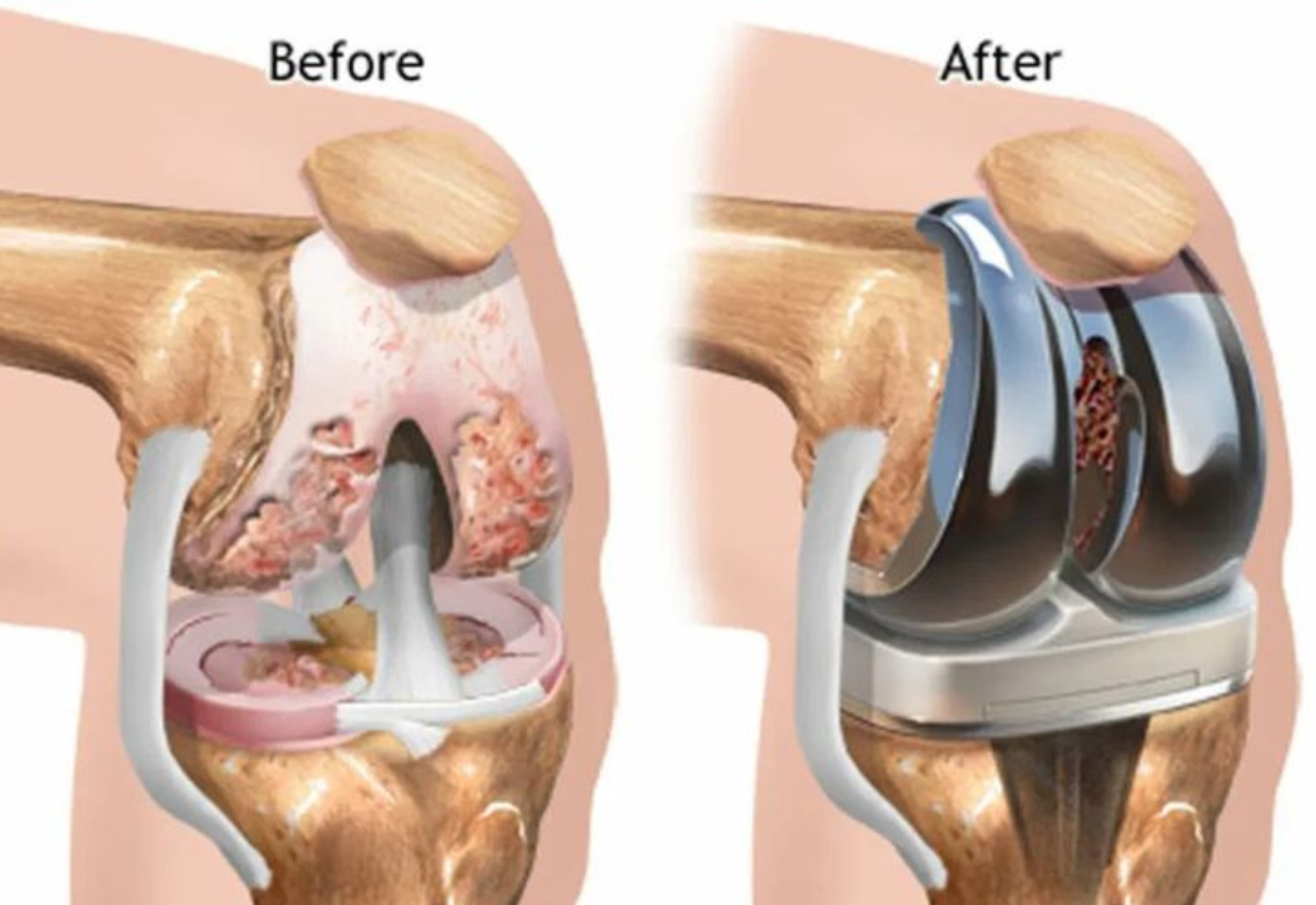 Orthopaedics and Joint Replacement